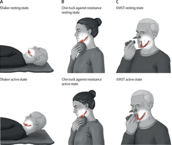 A Breakthrough In Swallowing Rehabilitation