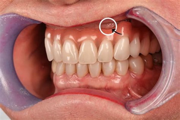 Day 3 After Immediate Dentures: Uncover Surprising Truths