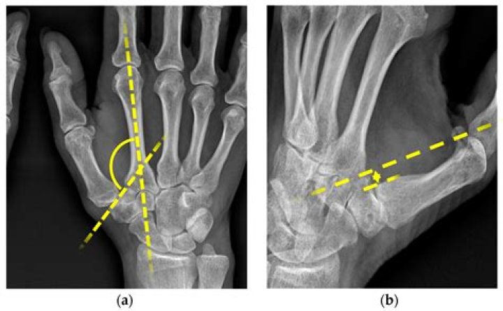Discover The Secrets Of Thumb Positioning: In Or Out?