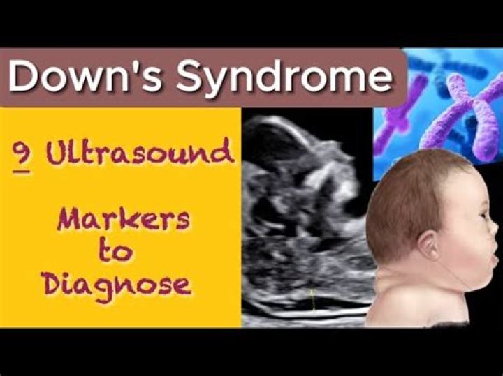 Down Syndrome Through A Unique Lens