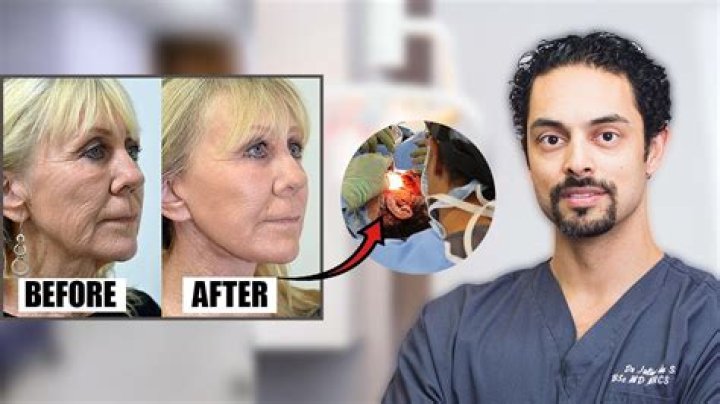 Joyce Vances Facelift Secrets Revealed