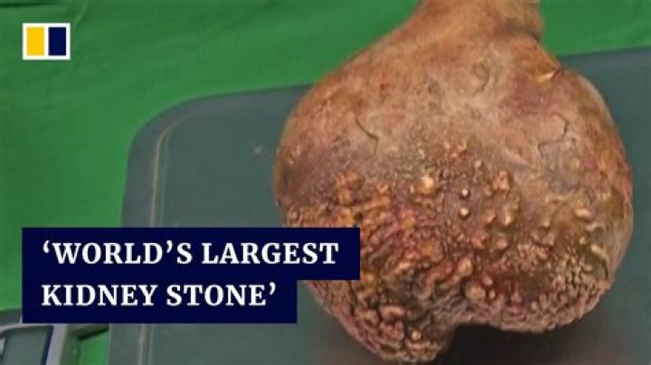 Largest kidney stones enters Guinness World Records |