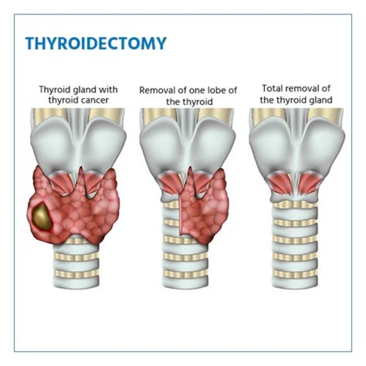 Unveiling The Secrets Of Thyroid Surgery With Dr. Joyce Vance
