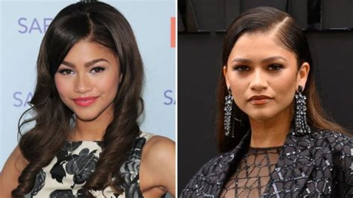 Zendaya's Plastic Surgery Journey Explored