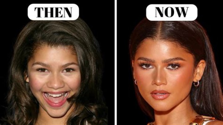 Zendaya's Plastic Surgery Journey: Uncovering The Truth